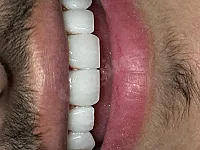 زراعة وتجميل الاسنان دمشق وريفها